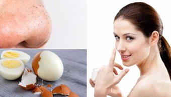 5 Cách trị mụn trứng cá bằng thiên nhiên tốt cho da tại nhà