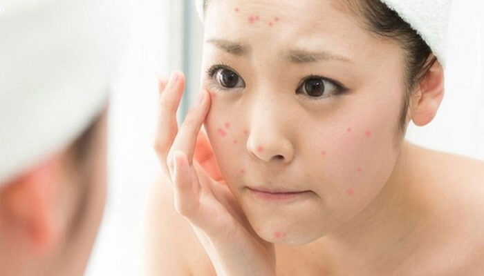 Chăm sóc da mụn thực hiện tẩy trang như thế nào giúp da khỏe đẹp?