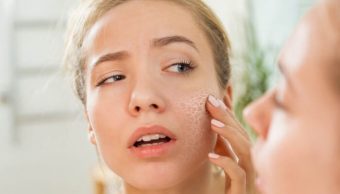 Vì sao da bị khô vào mùa đông? Cách khắc phục dưỡng da khô chăm sóc da mặt nhờn