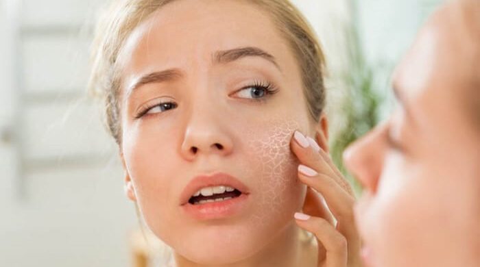 Vì sao da bị khô vào mùa đông? Cách khắc phục dưỡng da khô chăm sóc